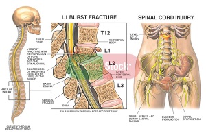 L1 Compression Burst Fracture with Spinal Cord Injury
